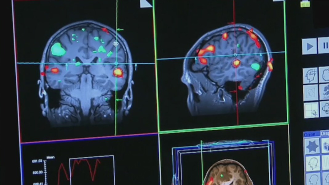 Researchers: COVID causes brain inflammation
