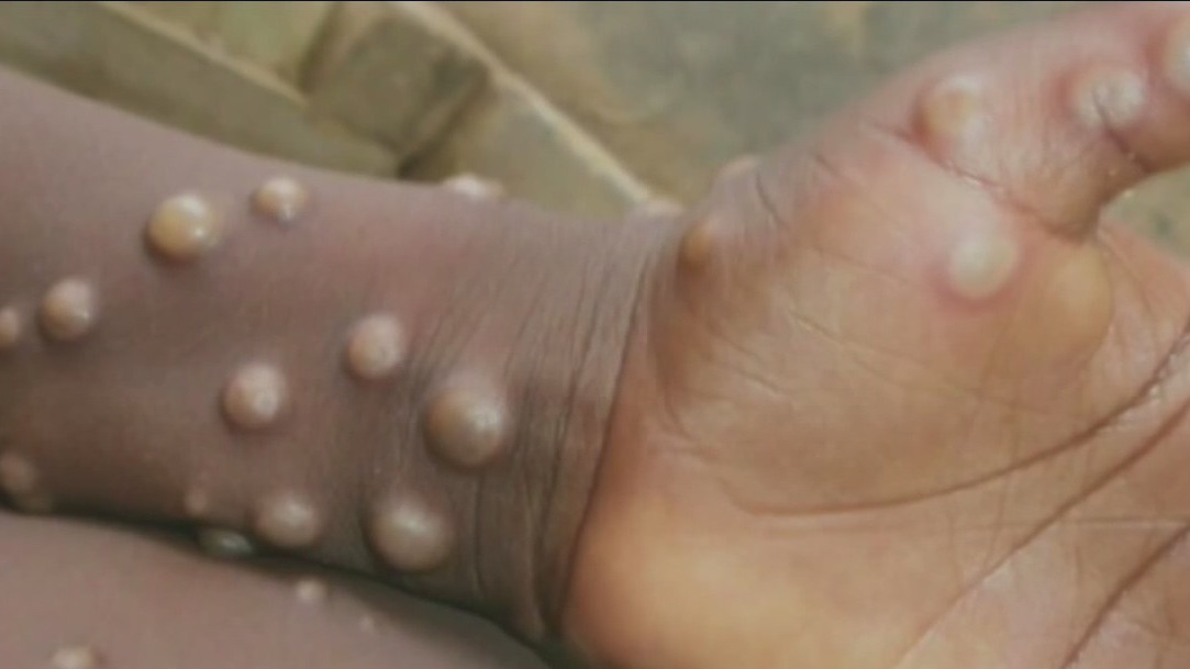 First possible case of monkeypox detected in California