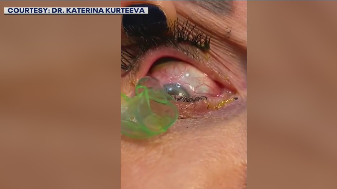 Newport Beach doctor removes '23 contact lenses' from patient's eye