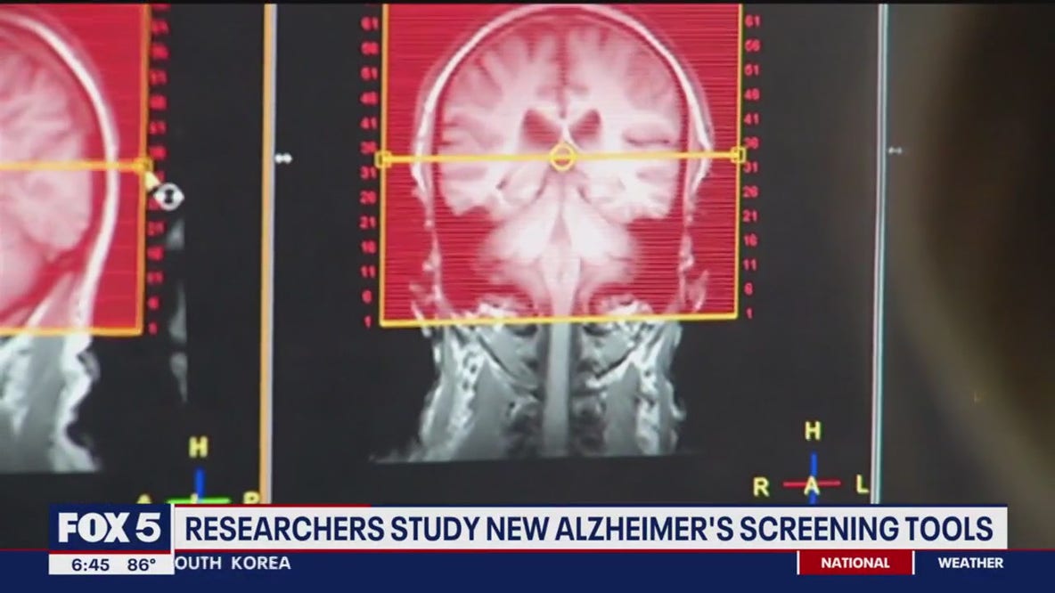 Researchers study new Alzheimer's screening