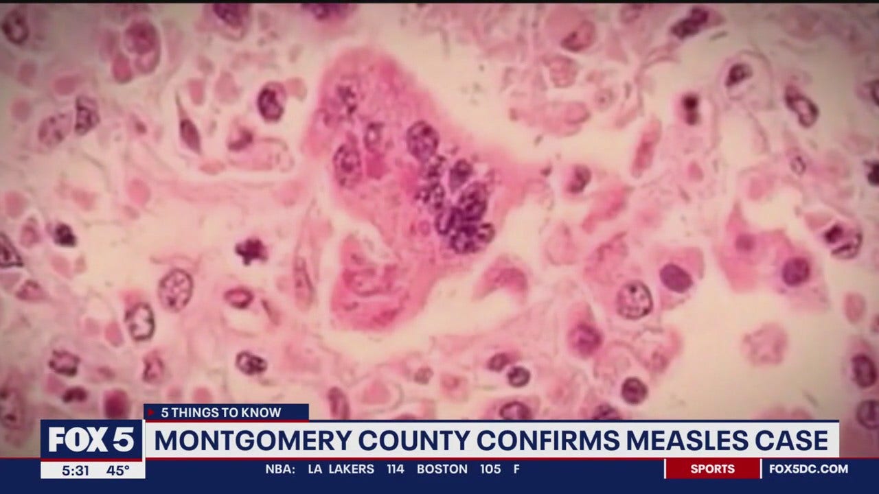 Maryland measles case confirmed. Check to see if you may have been