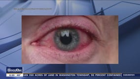 Latest COVID-19 variant causing pink eye