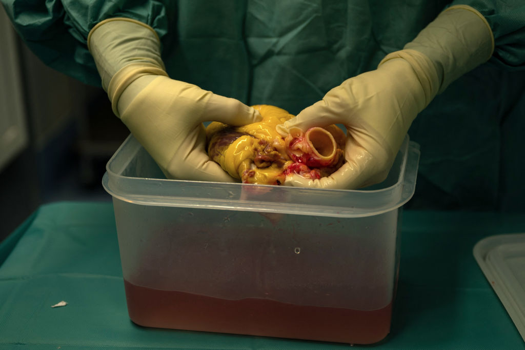 In Depth: Organ Transplants