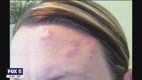 Who should get vaccinated against shingles