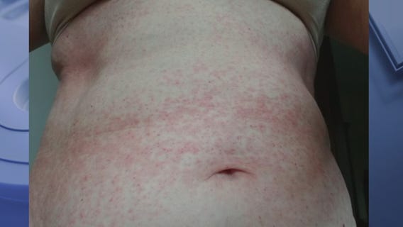 Doctor says Covid-19 rash is rare, but possible