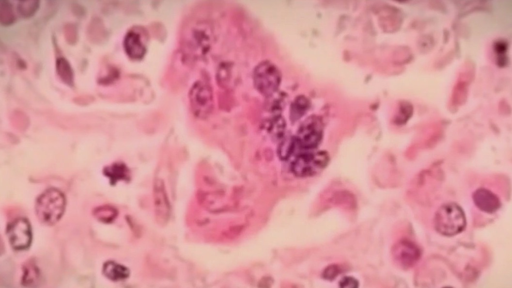 Measles exposure at LI Children's Medical Center