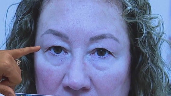 Heavy eyelid surgery