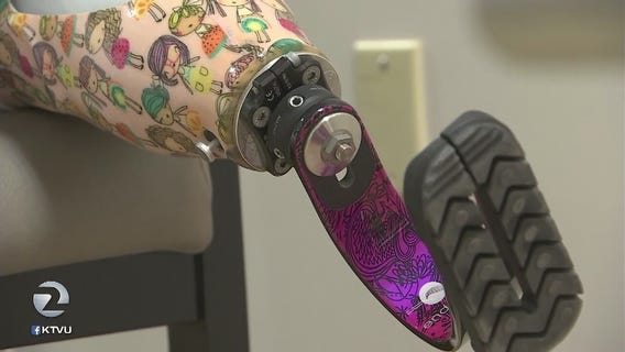 Lilly's new legs: Santa Rosa 9-year-old regains confidence