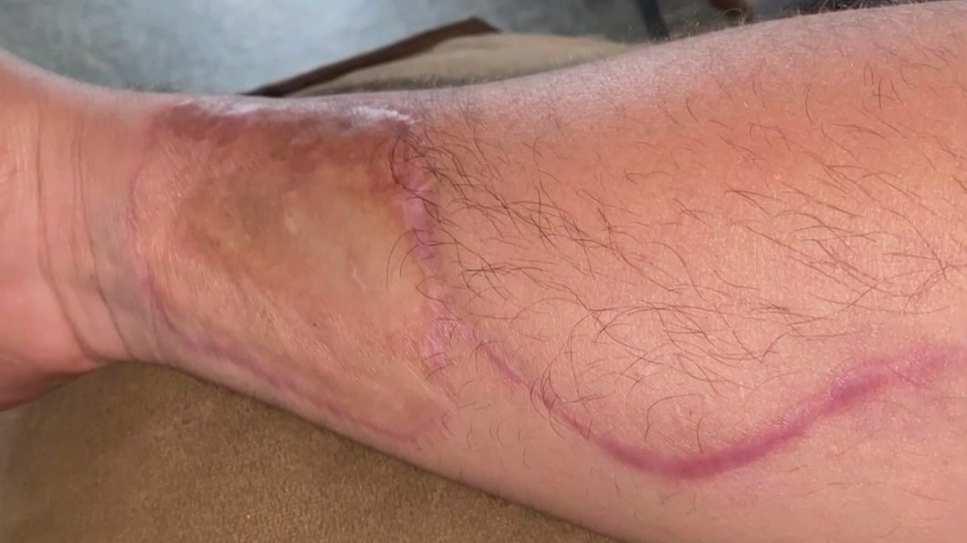 31-year-old shares oral cancer diagnosis