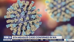 6th measles case confirmed in WA