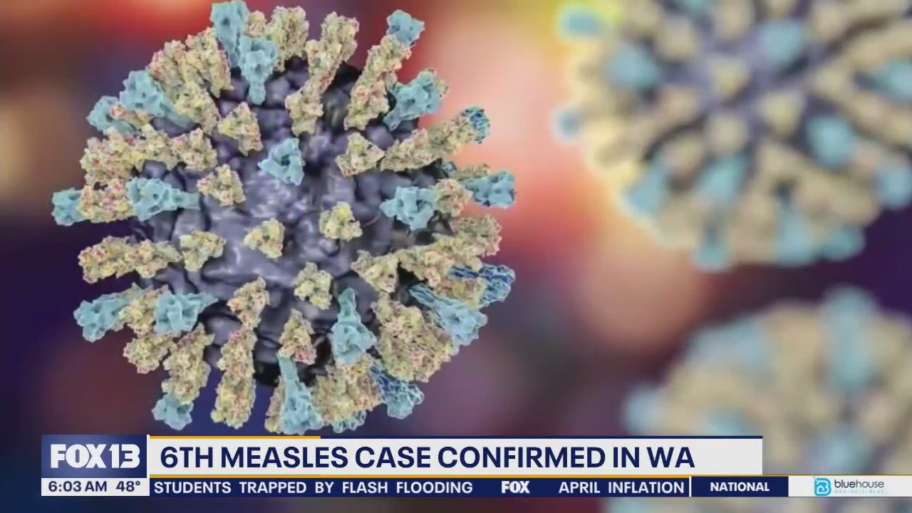6th measles case confirmed in WA