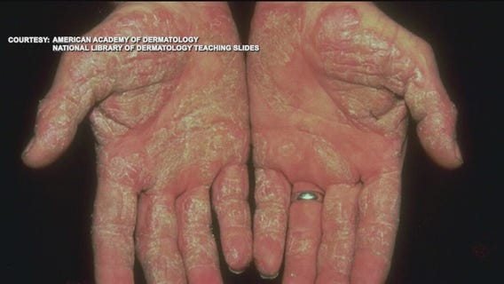 A breakthrough in plaque psoriasis?
