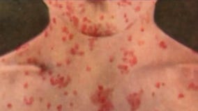 Measles cases confirmed in New Jersey