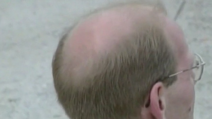 Cure for balding could be in your kitchen