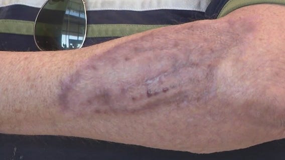 Burn victim warns against Arizona's heat