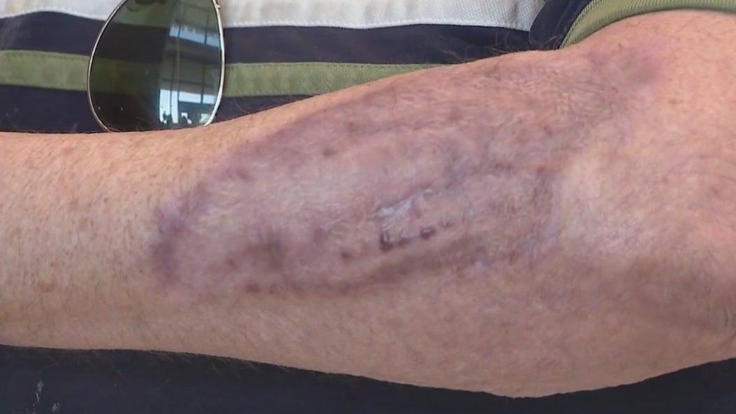 Burn victim warns against Arizona's heat