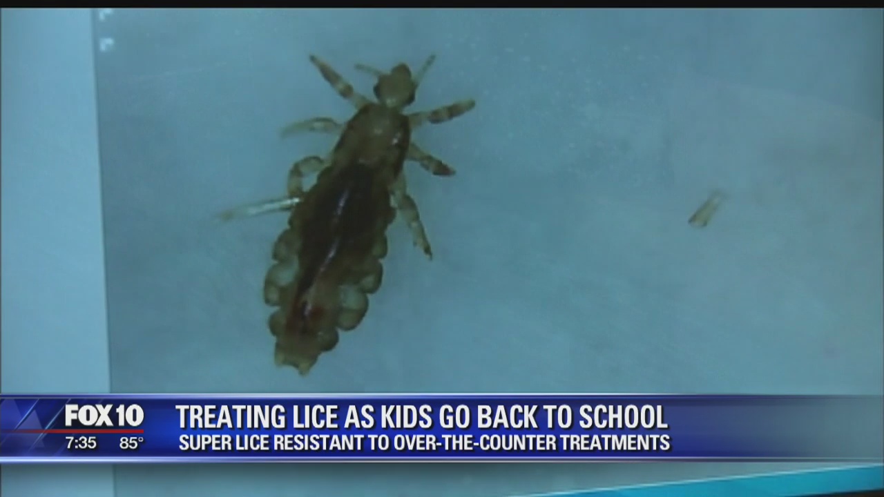 Treating lice as kids go back to school