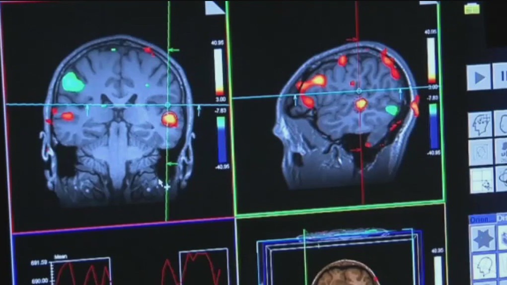 Scientists announce possible breakthrough in delaying Alzheimer's