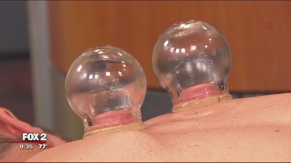 Cupping: why you're seeing it on Olympians and how to try it yourself