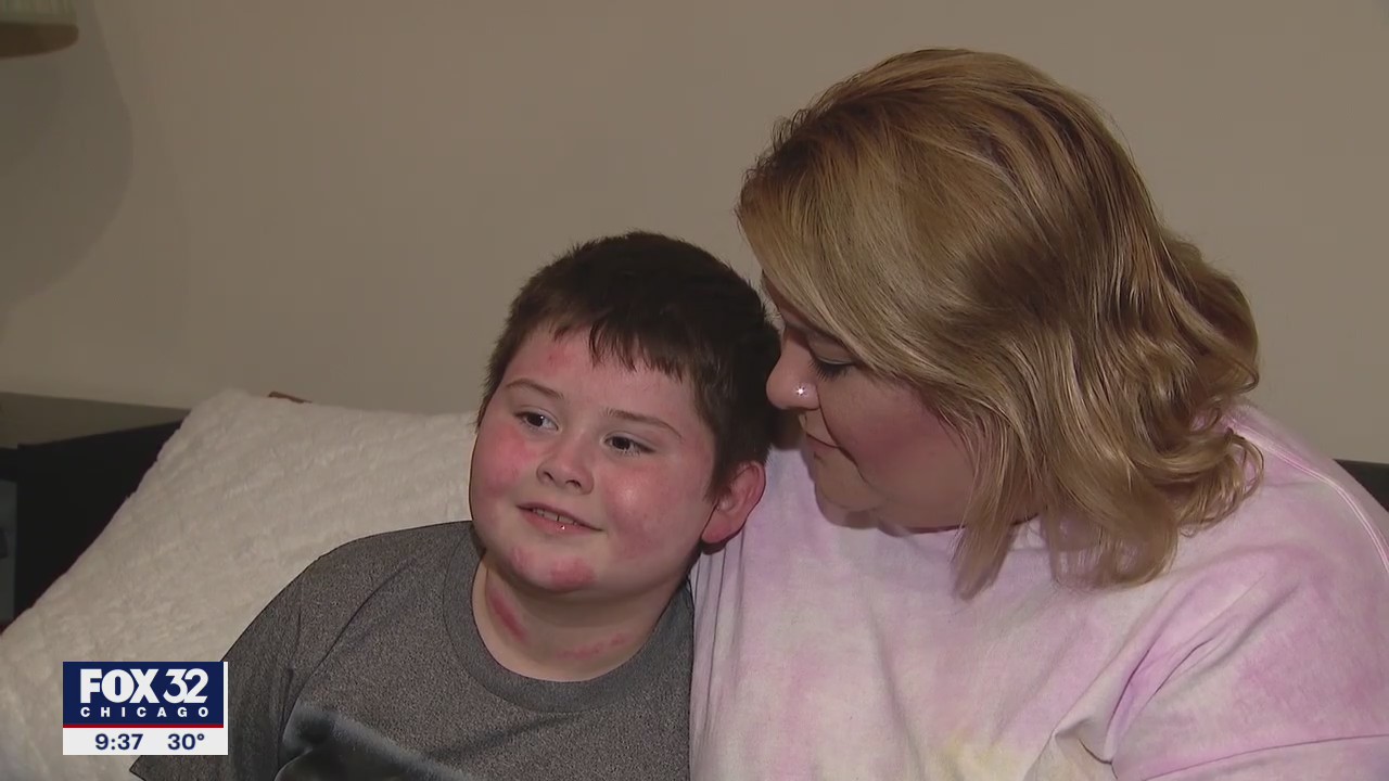 Chicago boy still recovering after suffering third-degree burns in house fire