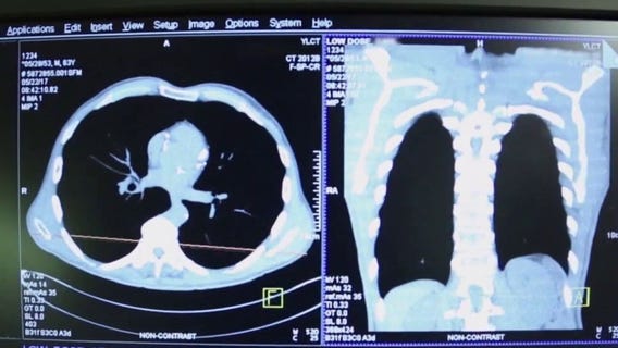 Cancer survival rates hit 70%, American Cancer Society report finds