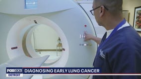 Low-dose CT scan detects lung cancer early