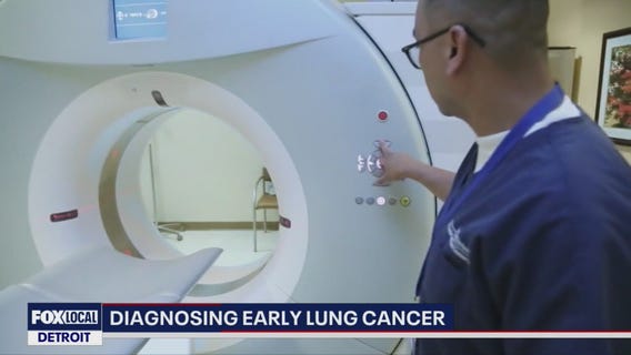 Low-dose CT scan detects lung cancer early