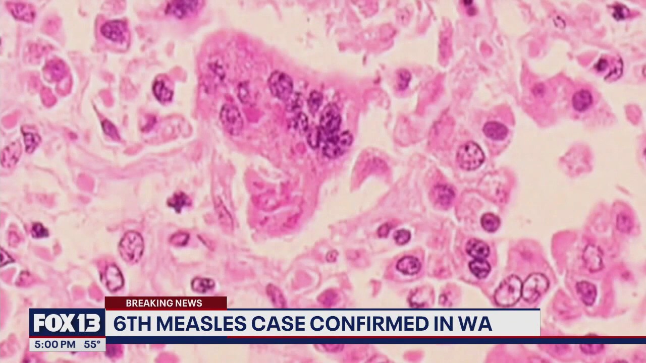 6th WA measles case confirmed in western WA