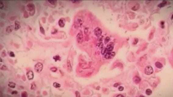 Chicago migrant diagnosed with measles; city's first case since 2019