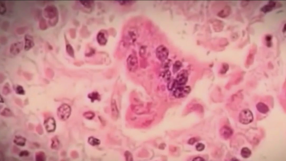 Chicago migrant diagnosed with measles; city's first case since 2019