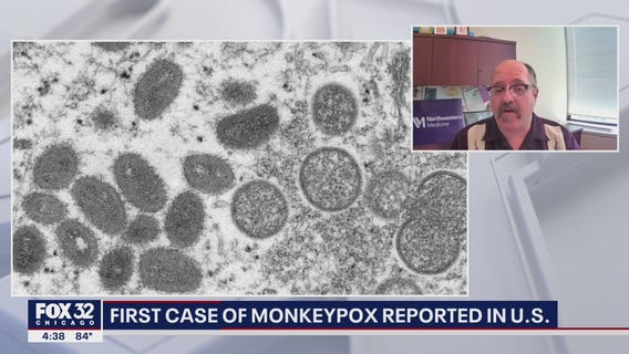Monkeypox in the US: First recent case of Monkeypox reported in Massachusetts