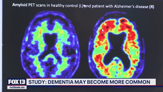 Study: Dementia may become more common