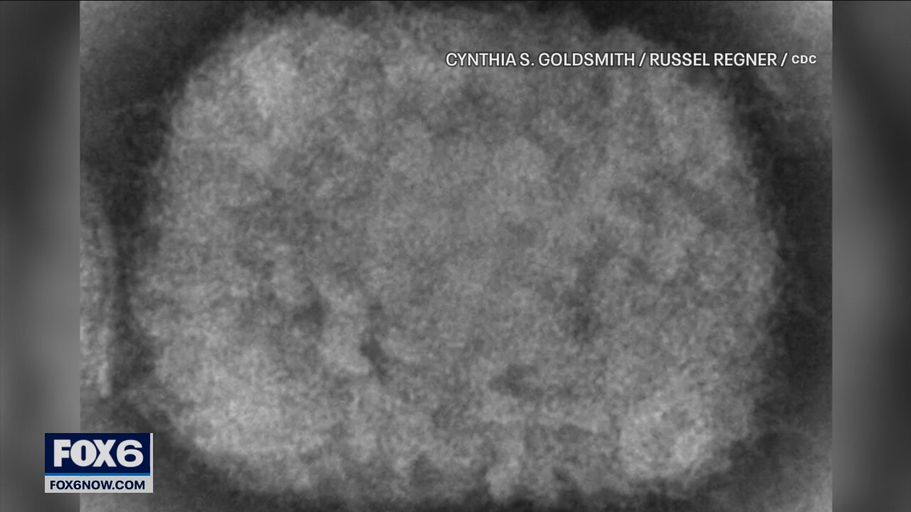 Wisconsin's 1st monkeypox case identified