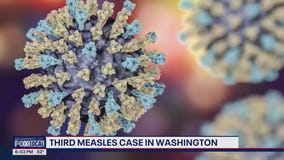 Third measles case of 2025 confirmed in Washington