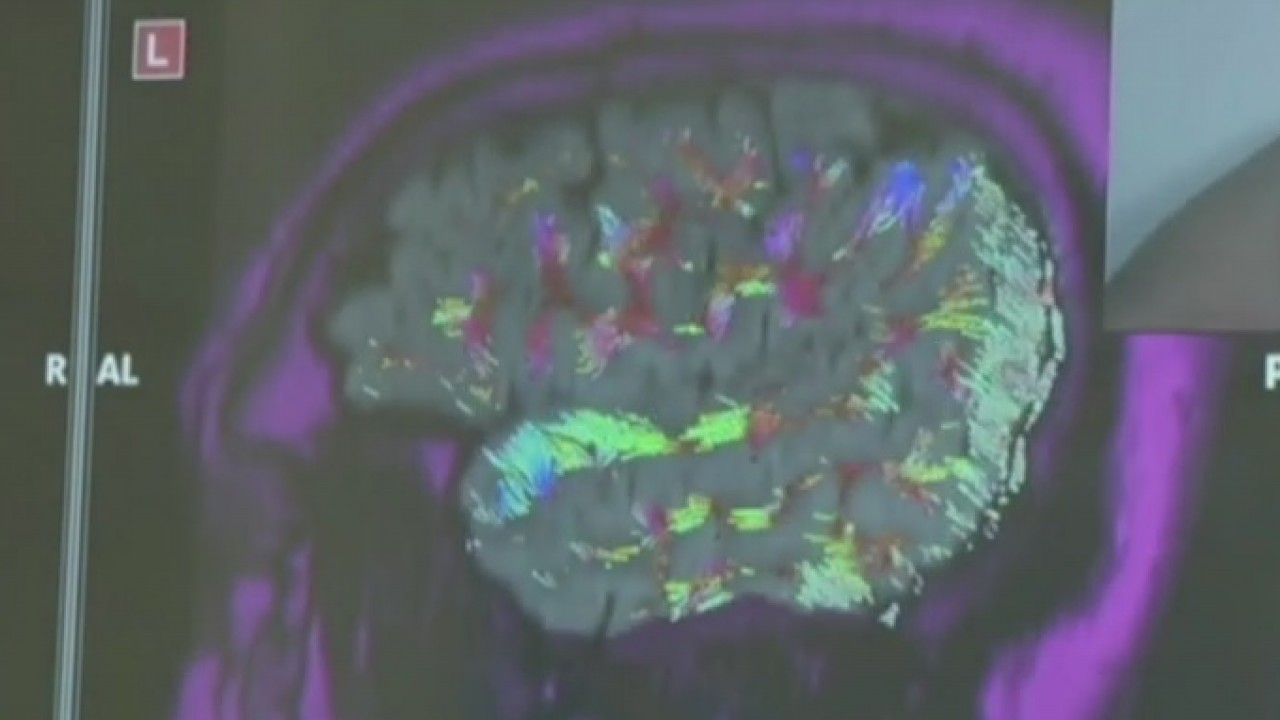 Alzheimer's disease and viruses