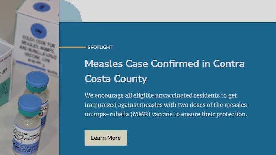 Measles case confirmed in East Bay, possible exposure at shopping mall, health officials warn