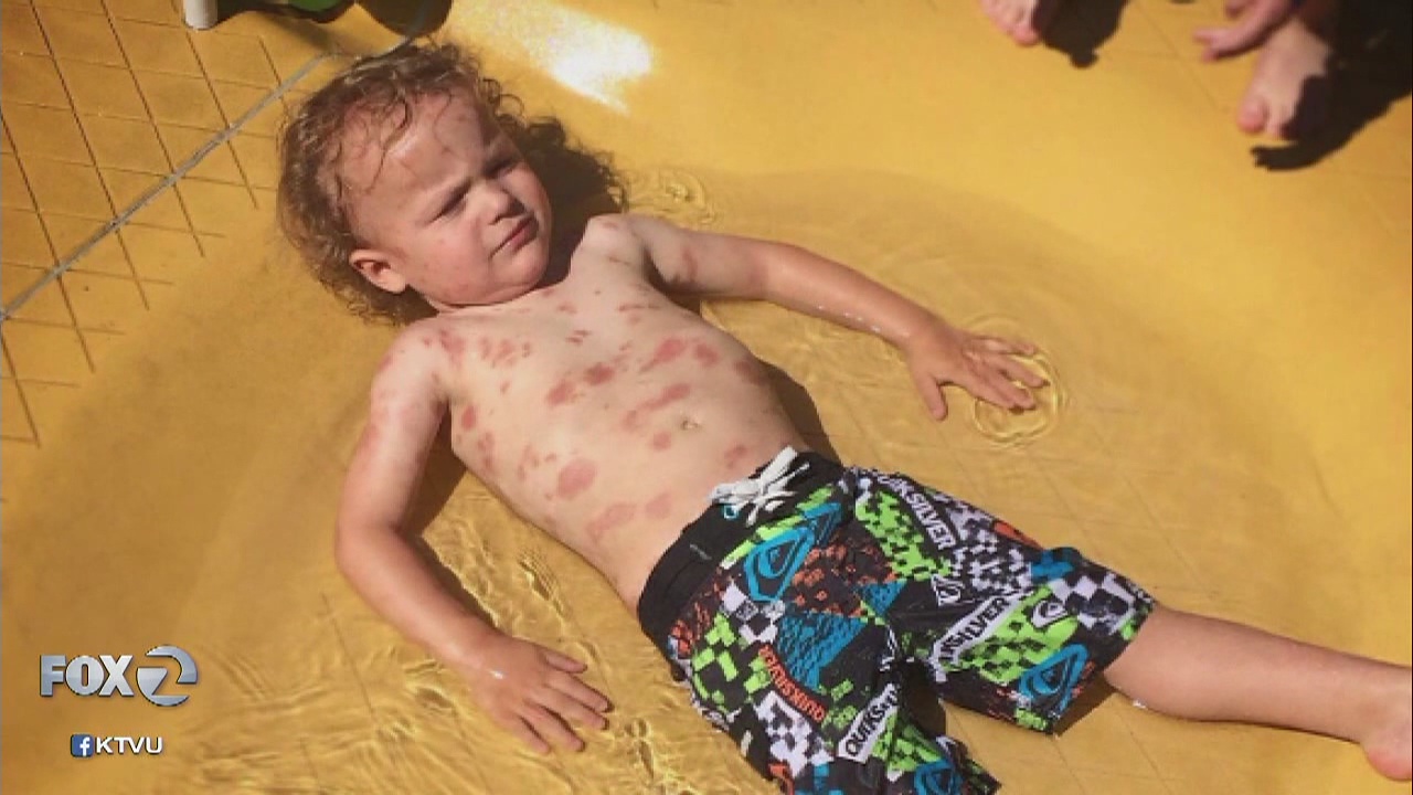 Gilroy Gardens Water Oasis apologizes over boy's rare skin condition