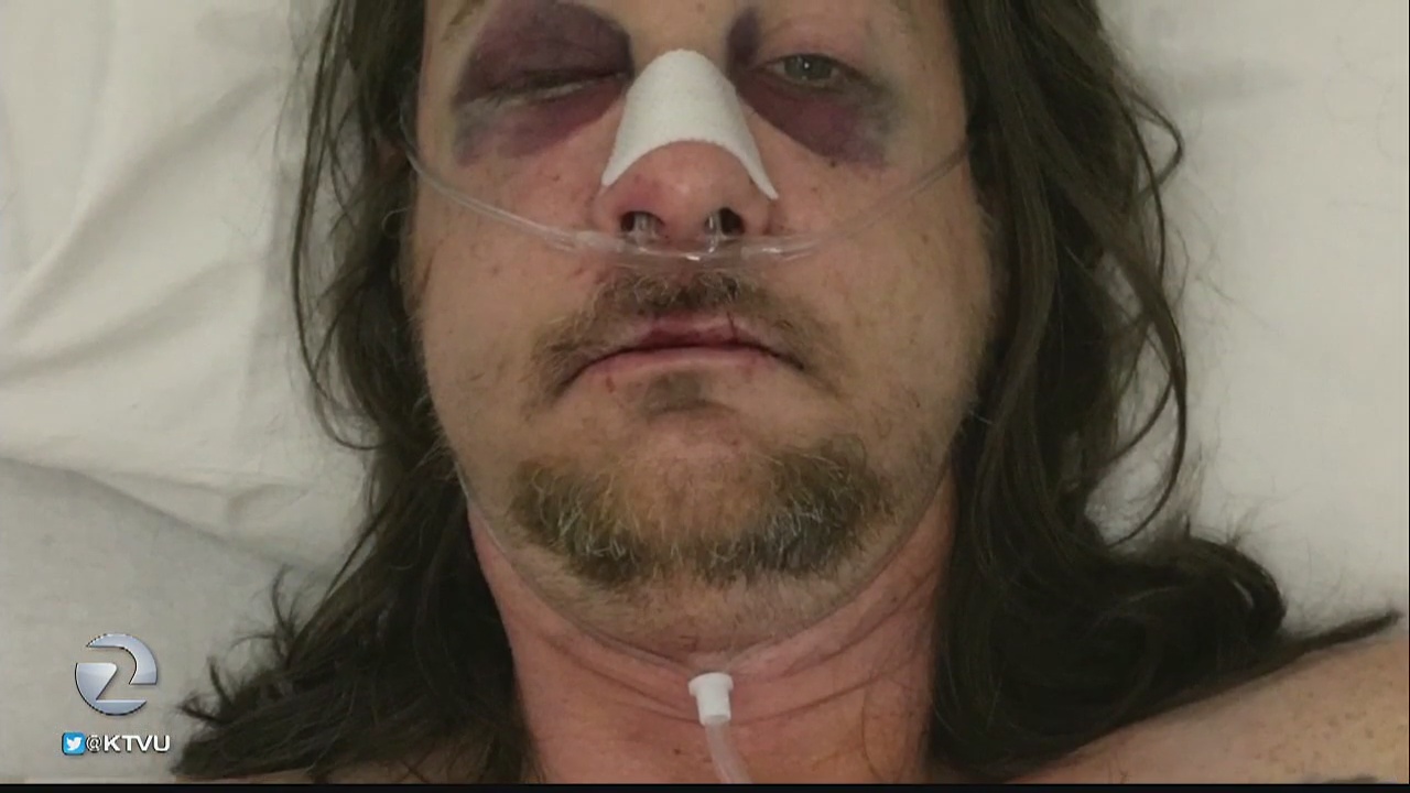 Man can't remember much from being attacked in Castro; police investigating