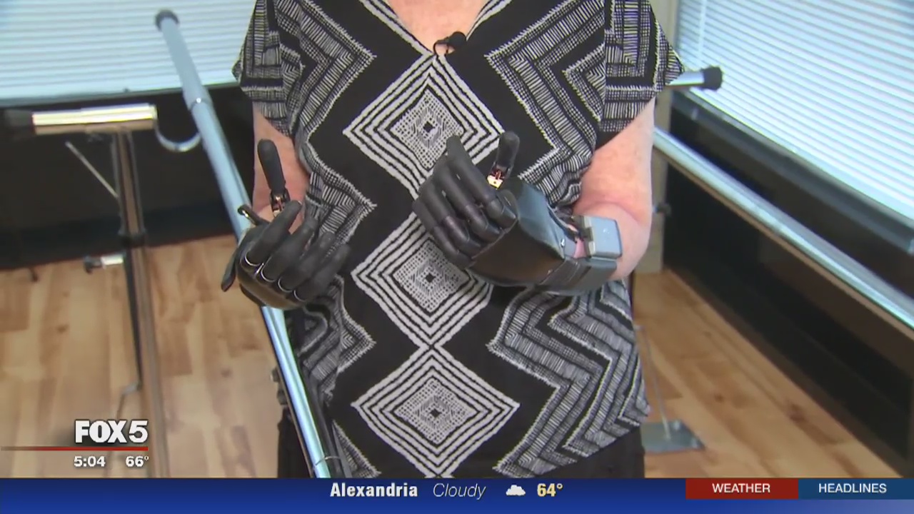 Quadruple amputee receives new prosthetic hands