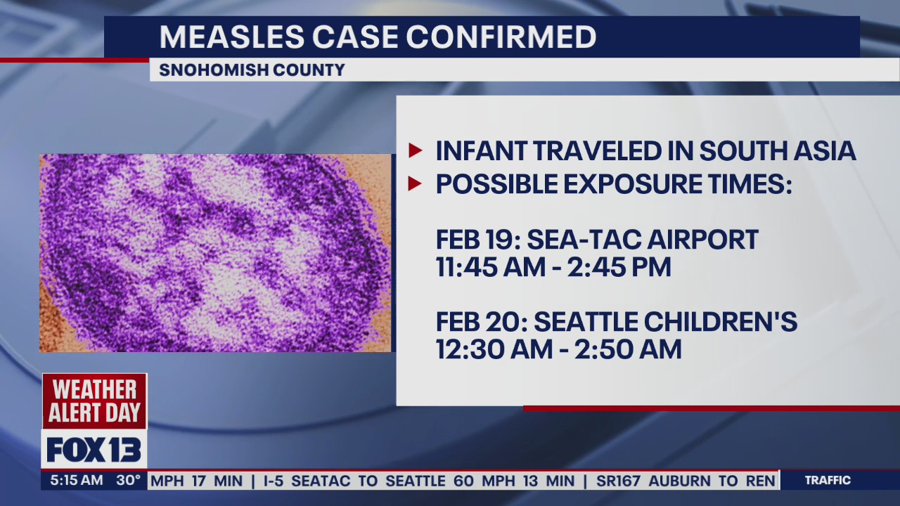Measles confirmed in Snohomish County