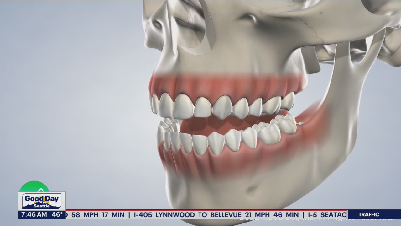 Local doctor offering free wisdom teeth removal