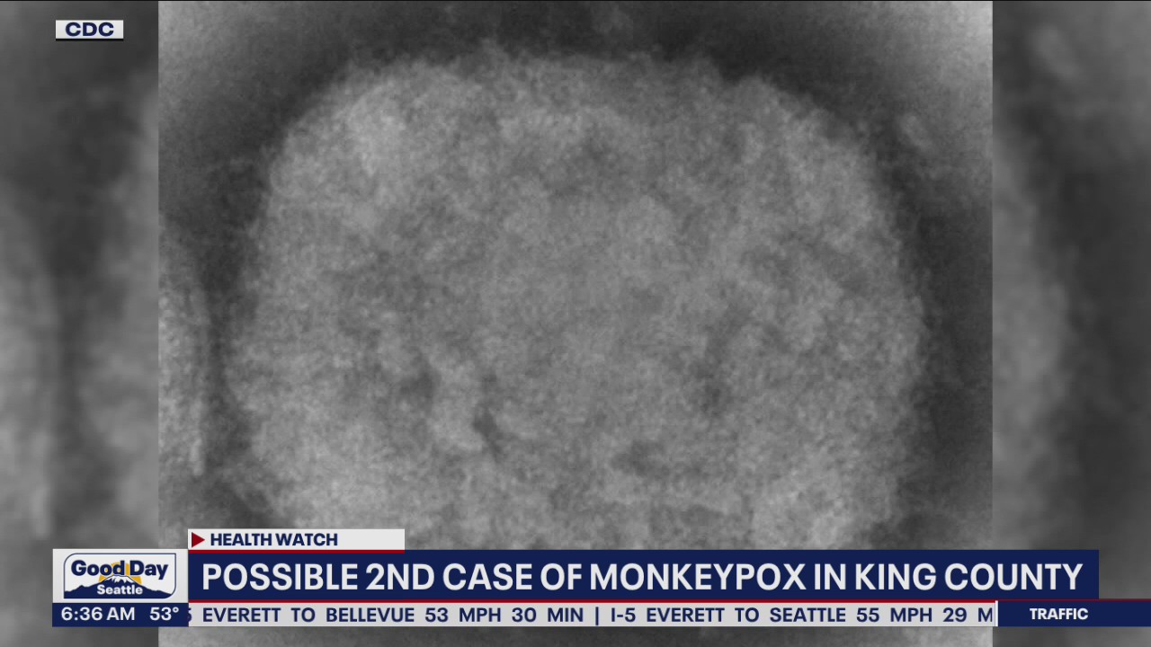 Possible 2nd case of monkeypox in King County