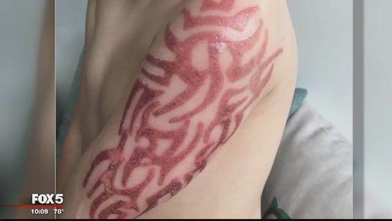 Va. boy gets allergic reaction after getting black henna tattoo during beach trip
