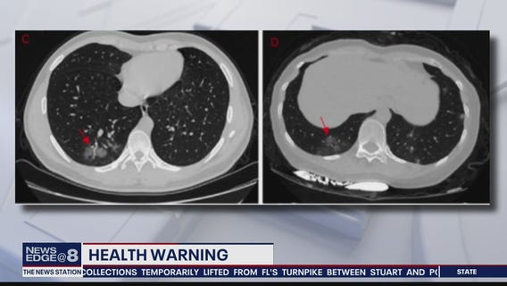 COVID-19 damages lungs of asymptomatic and most severe patients alike