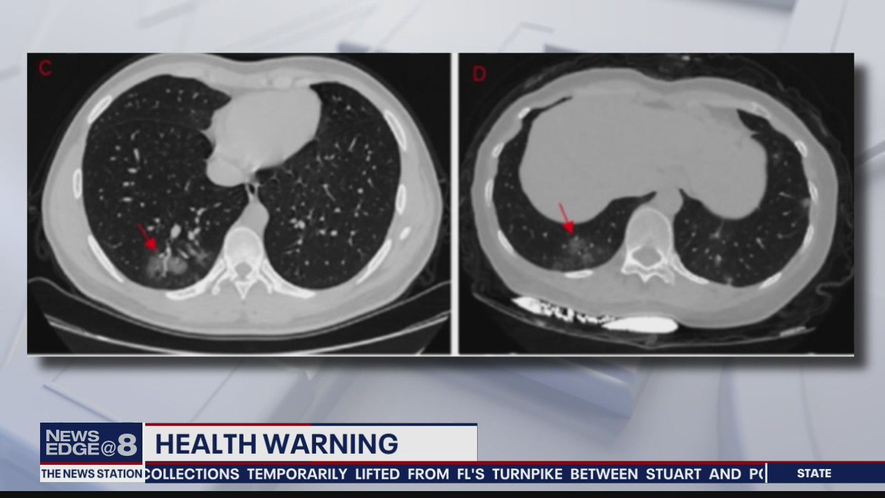 COVID-19 damages lungs of asymptomatic and most severe patients alike