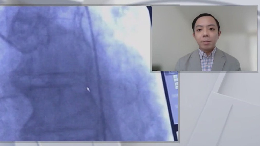 UCSF Study: Cardiovascular deaths in the U.S. reach record highs in 2023