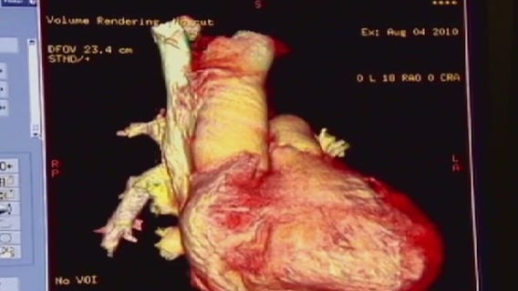 Half of Americans over 65 face high cholesterol risks