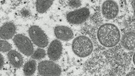 Monkeypox cases reported in United States, around the world