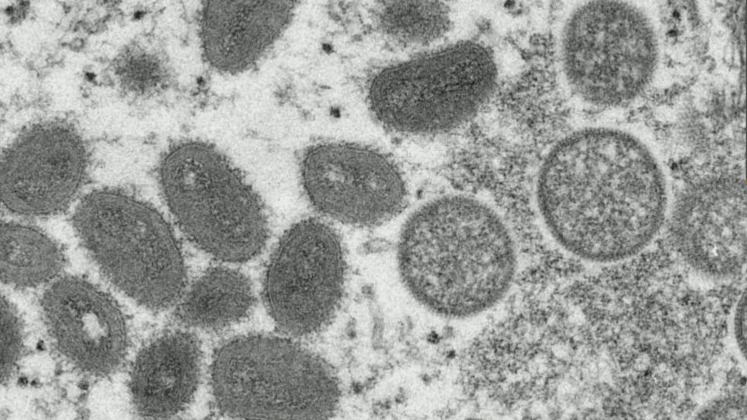 Monkeypox cases reported in United States, around the world