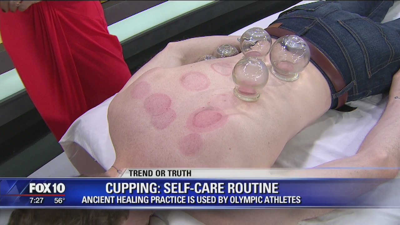 Cupping therapy, an alternative medicine to stimulate blood flow